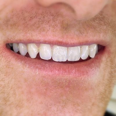 Composite Bonding - Smile 17 before